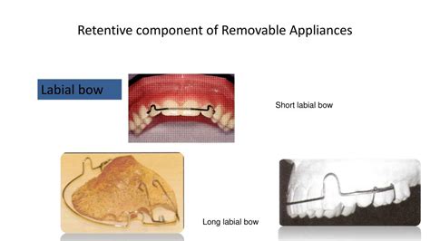 Ppt Types Of Orthodontic Appliances Powerpoint Presentation Free Download Id 2007769