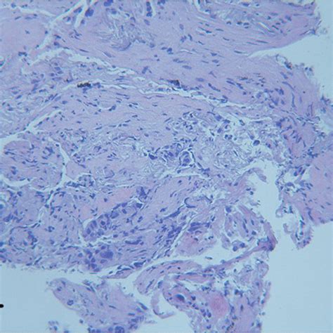 Hematoxylin And Eosin Staining For Lung Adenocarcinoma The Sample Was