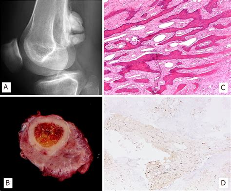 X Rays Of Distal Femur Exhibiting An Exophytic And Sclerotic Mass