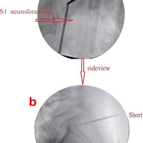 A Sacral Anteroposterior View Under Fluoroscopy Depicting A Combination Download Scientific