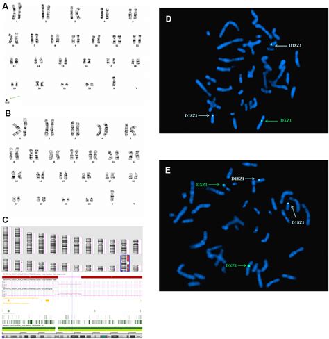 Prenatal Diagnosis And Molecular Cytogenetic Identification Of Small