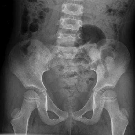 Coxa valga | Radiology Reference Article | Radiopaedia.org