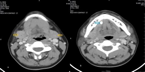 An Unusual Presentation Of Chronic Sclerosing Sialadenitis Of