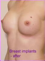 Breast Augmentation Prices In Budapest Hungary