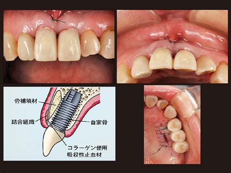 【モリタ】インプラント抜歯即時埋入による上顎前歯部審美修復治療｜デンタルマガジン｜歯科情報ポータルサイト デンタルプラザ