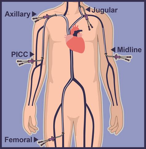 Non Tunneled Central Venous Catheter