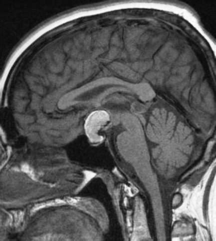 Clin Med Pituitary Disorders Flashcards Quizlet