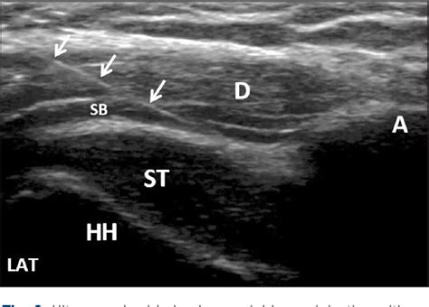 Figure 2 From Comparison Of Ultrasound Guided Subacromial