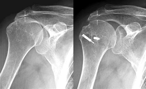 Figure 2 From Arthroscopic Superior Capsule Reconstruction Using