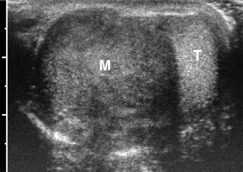 Paratesticular Rhabdomyosarcoma Transverse Sonogram In A 15 Month Old