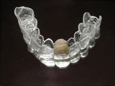 essix retainer news dentagama essix retainer retainer