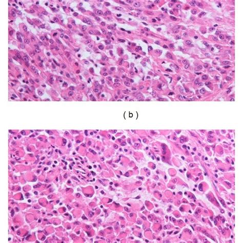 Histological Findings A Proliferation Of Spindle Cells With Abnormal