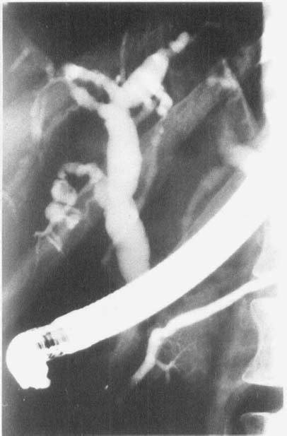 Ercp Showing A Dilated 11 Mm Irregular Common Bile Duct Intrahepatic Download Scientific