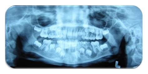 Orthopantomograph Showing Mandibular Left Primary Second Molar