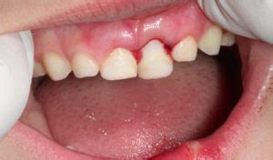 Hiperplasia Gingival Causas S Ntomas Y Tratamiento Dental Care