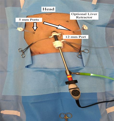 The Surgical Management Of Complicated Peptic Ulcer Disease