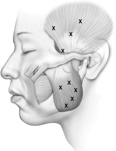 Botulinum Toxin Treatment Of Temporomandibular Disorders Masseteric Hypertrophy And Cosmetic