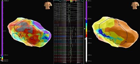 Advisor Hd Grid Mapping Catheter Se Case Library Abbott