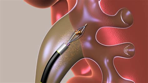 Ureteroscopy - YouTube