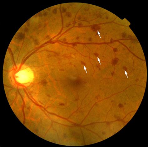 Atypical Diabetic Retinopathy The Bmj