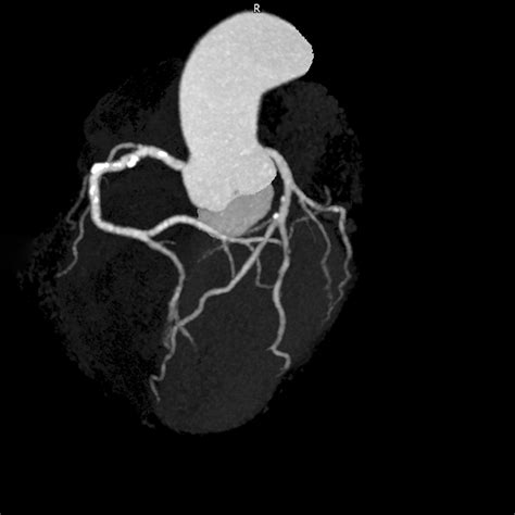 Treatment of angina – tips and tricks - Medical Forum