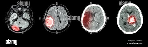 Colección tomografía computarizada del cerebro y múltiples enfermedades