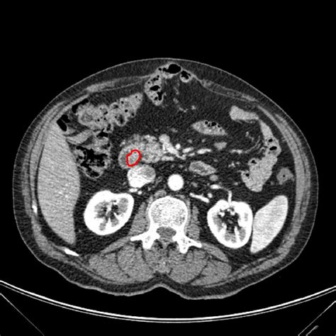 Figure 2 From Ct Evaluation Of Small Bowel Carcinoid Tumors Semantic