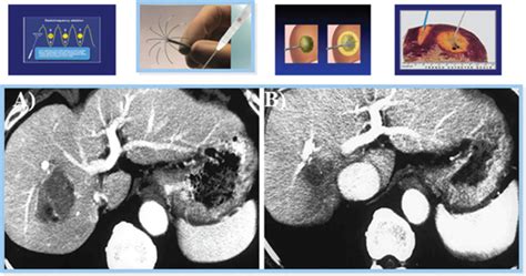 Figure Image Guided Radiofrequency Ablation For Hepatocellular