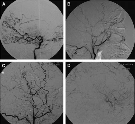 A 33 Year Old Woman Who Presented With Left Sided Weakness After 2