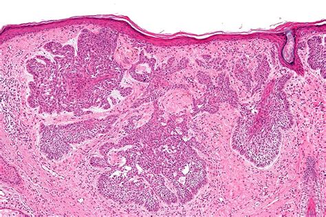 Basal cell carcinoma pathophysiology - wikidoc