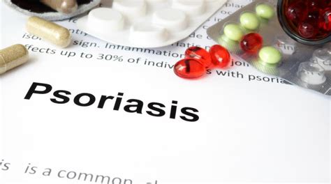 9 Tips For Keeping Up With New Psoriasis Treatments