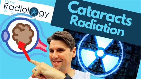 Radiation Cataracts Radiologic Technologists Youtube