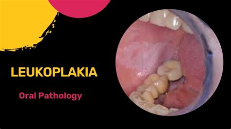 Leukoplakia White Patch Oral Pathology Neet Mds Dental Care