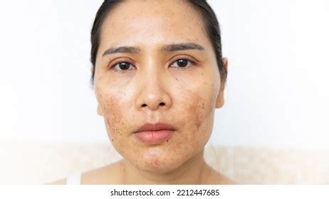 432 Skin Burn Laser Treatment Images, Stock Photos & Vectors | Shutterstock