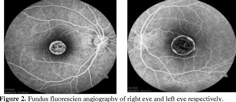 Figure 2 From “ A Case Report On Best ’ S Vitelliform Macular Dystrophy ” Semantic Scholar