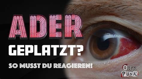 Wie gefährlich sind geplatzte Adern im Auge Augenoptiker erklärt