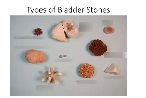 types of bladder stones Diagram | Quizlet