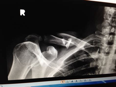 broken collar bone, surgery or no? | Mountain Bike Reviews Forum