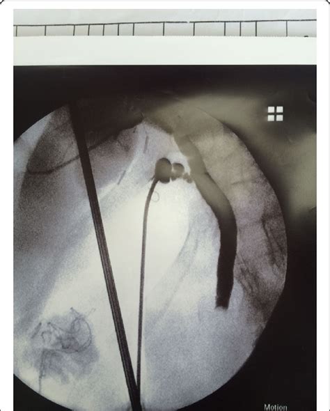 Intraoperative Cholangiogram Showing A Filling Defect That Prevents