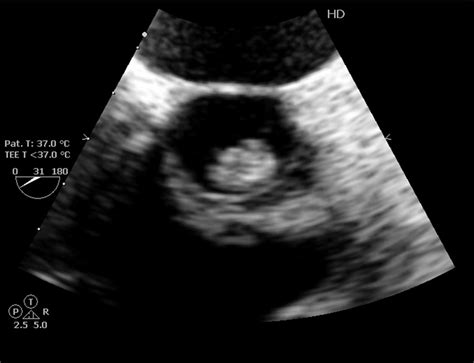 Aortic Valve Short Axis In Tee Showed Large Vegetation Attached With Download Scientific