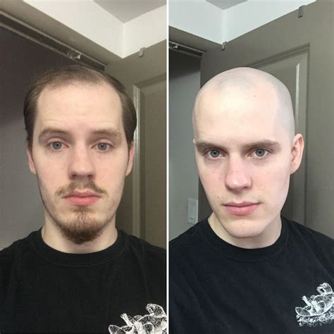 I Spent Years Afraid And Anxious About Going Bald Finally Decided To Shave It And I Couldn’t Be