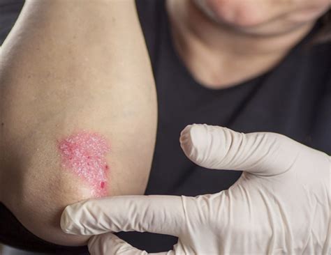 Une étude révèle un lien entre le psoriasis et la maladie articulaire