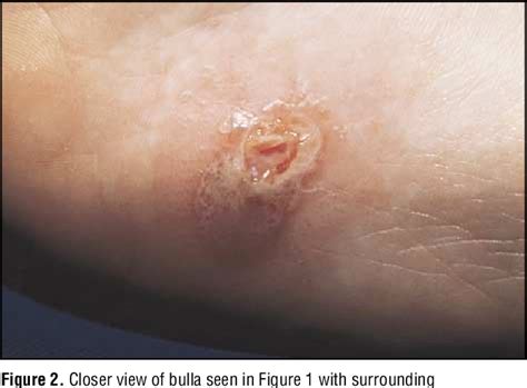 PDF Inflammatory Tinea Pedis Manuum Masquerading As Bacterial