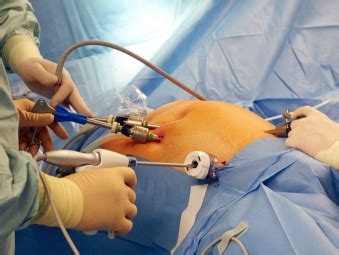 Laparoscopic And Robotic Hernia Surgery Institutes For Specialized