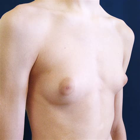 Galerie Prom N Gynecomastie Klinika Esth Praha