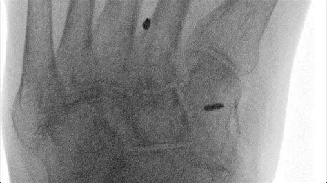 Arthrex Knotless Mini TightRope Fixation For Lisfranc Injuries