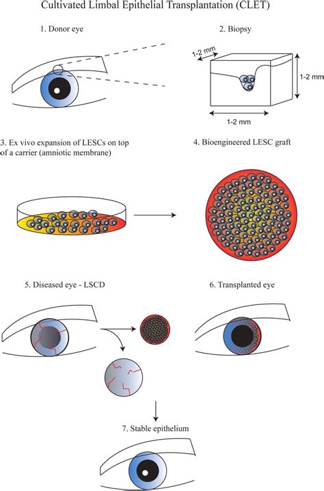 2 Procedure Of Cultivated Limbal Epithelial Transplantation CLET 1