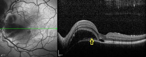 Diagnosis And Management Of Vogt Koyanagi Harada Disease In A