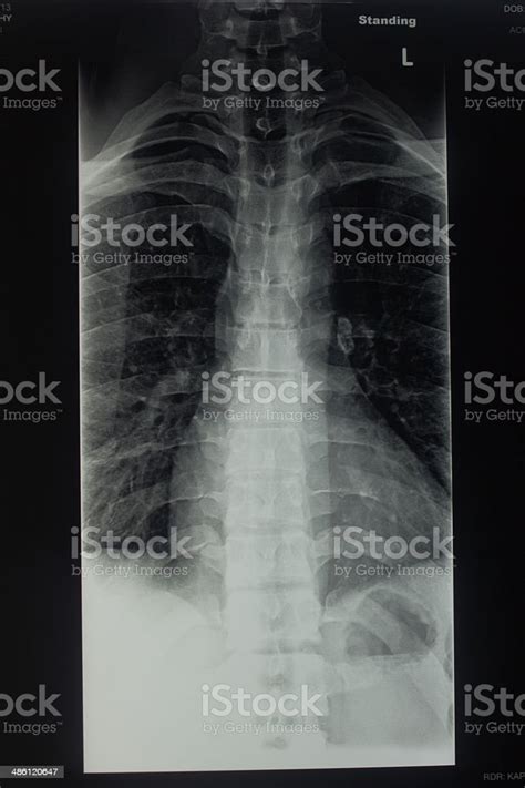 Xray Of The Thoracic Spine Stock Photo - Download Image Now - Chest ...