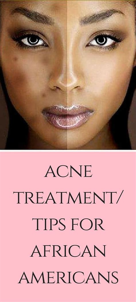 Acne Treatments for African American Skin